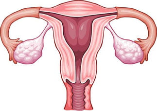 дисфункция яичников и беременность