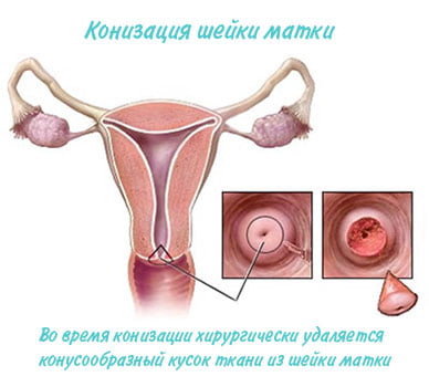 Беременность после конизации шейки матки
